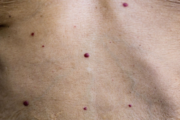 Cherry angioma removal in Austin TX