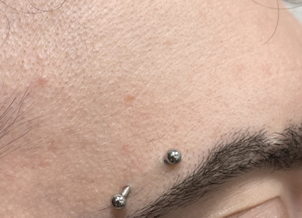 Forehead after Cherry Angioma Removal