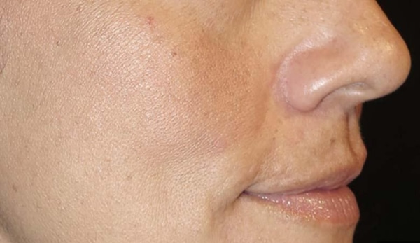 Woman teenager nose and cheek after skin clearing procedure