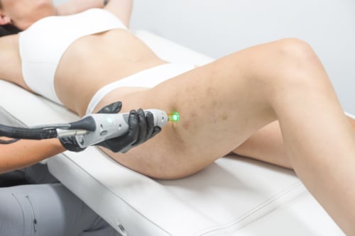 Beautician does laser hair removal procedure to woman thigh