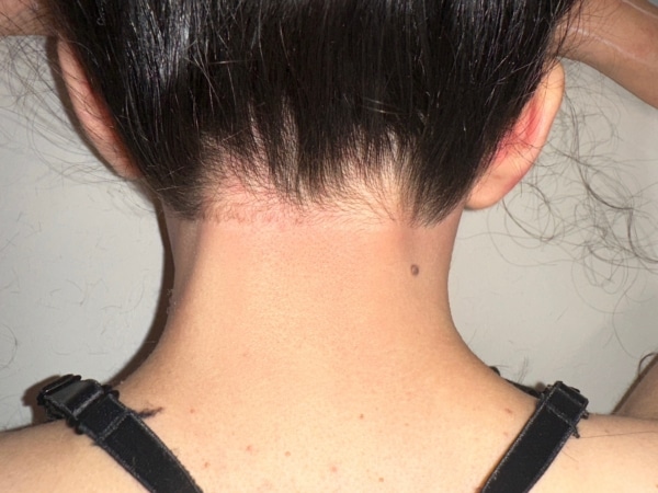 Back of the neck after Laser Hair Removal