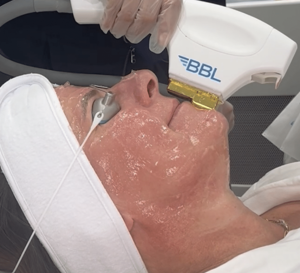 Client receiving BBL Hero treatment on face