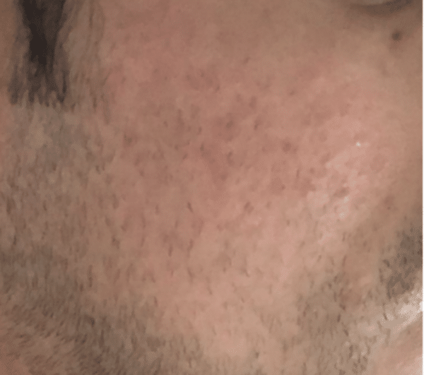 Cheek of a transgender after Morpheus8 treatment