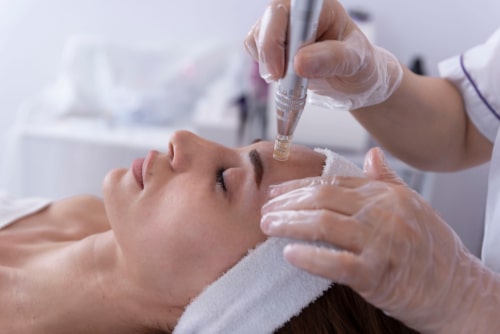 Close up of cosmetologist applying facial microneedling treatment on face of young woman