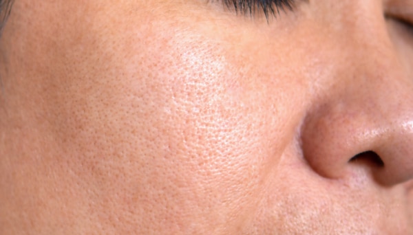 Close up of a woman face after PICO Genesis procedure