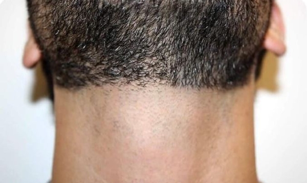 Close up photo of a man neck after Café Au Lait removal