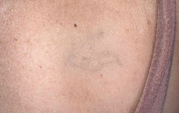 Close up photo of a tattoo on a teenager after laser removal