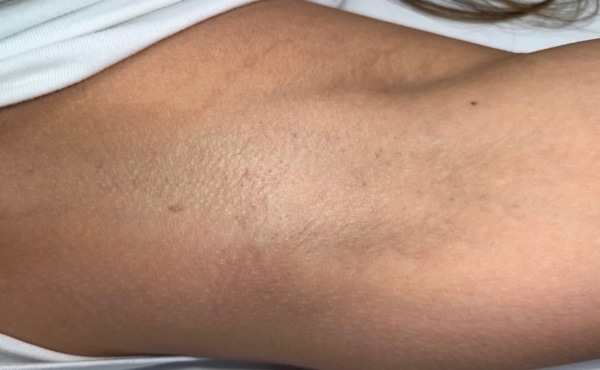 Armpit after Laser Hair Removal
