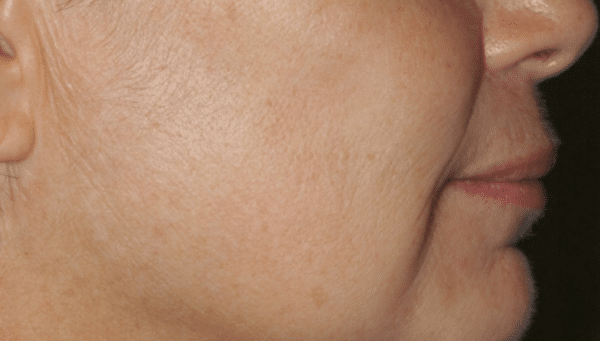 Dark Spot Removal on Face Area - After Treatment Photo