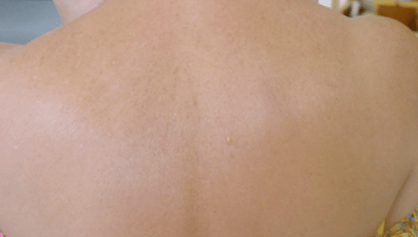 GentleMax Sun Sports - Photo After Removal of Dark Spots