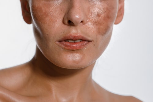 Close up of a woman face with hyperpigmentation