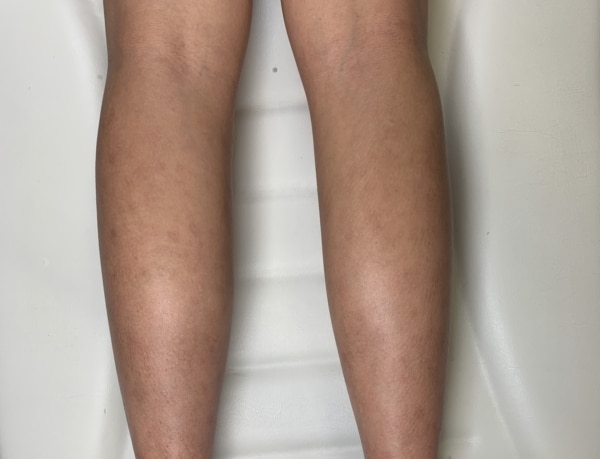 Teenager legs after Pico Genesis procedure