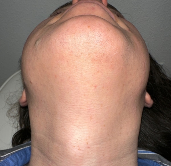 Neck and chin after Laser Hair Removal