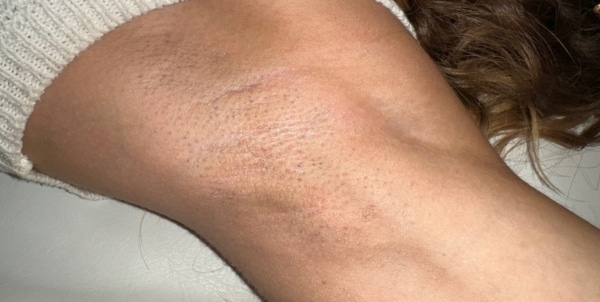 Armpit after Laser Treatment for PCOS