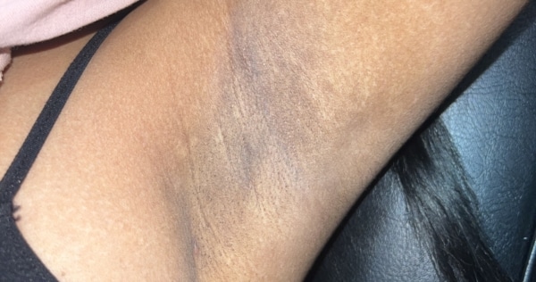 Armpit after Laser Treatment for PCOS