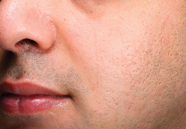 Close up of a man face after microneedling treatment