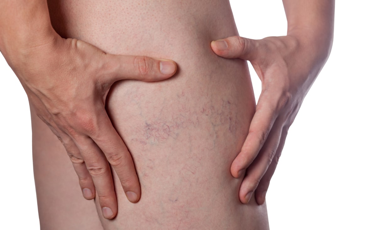 Spider Vein Removal: A Solution for Men’s Skin Concerns Spider Vein Removal: A Solution for Men’s Skin Concerns