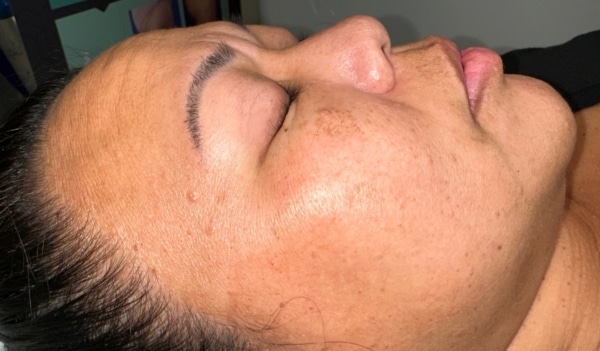 Asian woman cheek after Melasma Removal