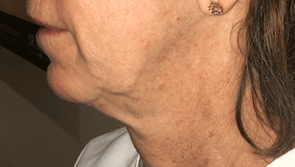 Morpheus8 Neck After Treatment