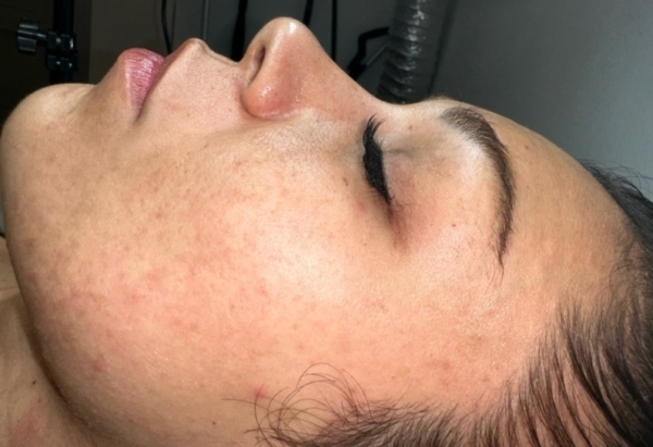 pico genesis after clear skin