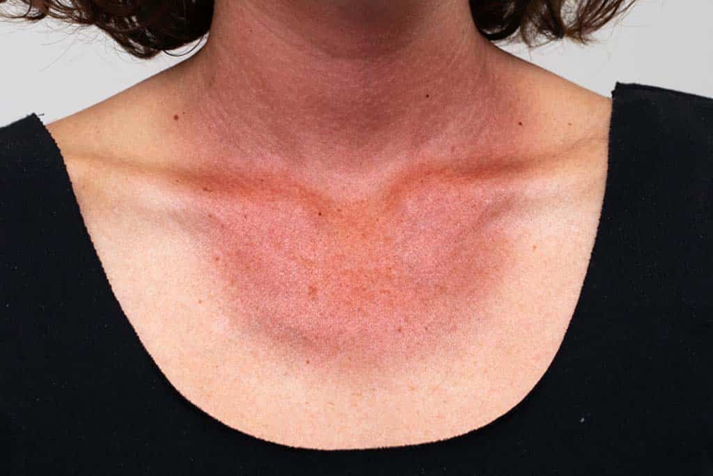 Can You Treat Redness & Broken Capillaries on the Body? What to know before you book.