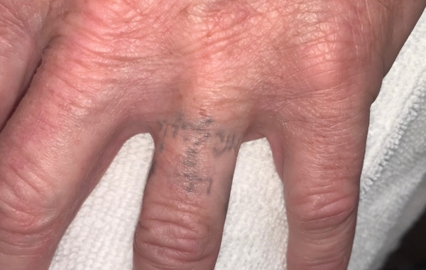 After Laser Tatoo Removal from the ring finger