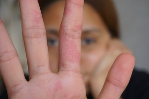 Teenage girl with port-wine stain on her hands