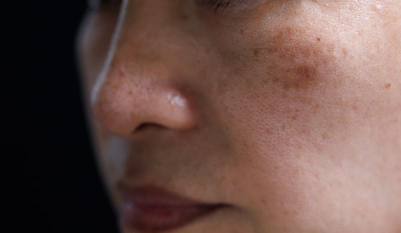 melasma on woman face