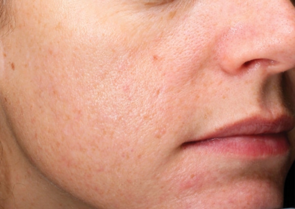 Close up of woman face after microneedling treatment
