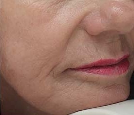 Woman nose and mouth after Pico Genesis FX procedure