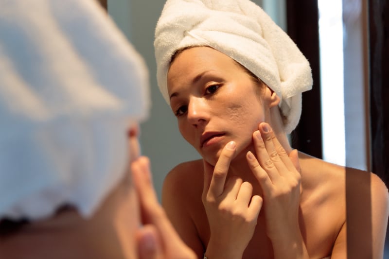 young woman looking her acne scars on the mirror